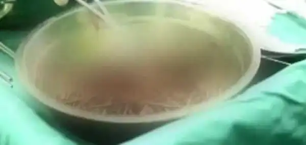 Student Turns Suicidal And Swallows Nails After Being Continuously Bullied. Photos